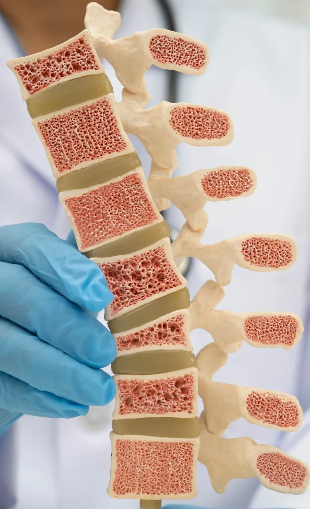 Close-up of a spinal disc anatomical model held by a clinician, showing the discs between vertebrae